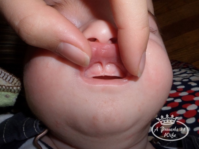 3 week old with a lip tie